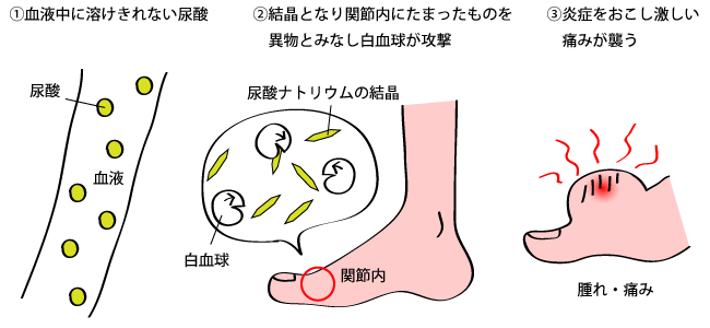 付け根 痛み の 指 の 足 の 足の指が痛い！痛む部位や症状別に足の指が痛む原因疾患について解説！