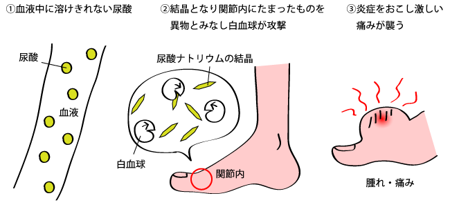 痛風 症状